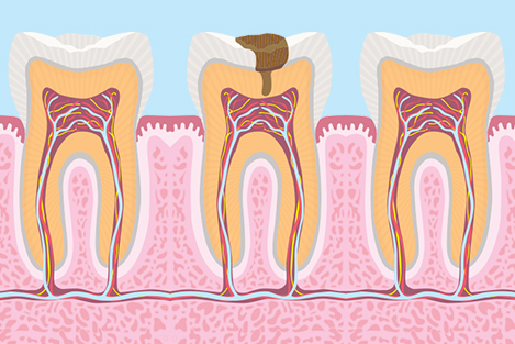 Root Canal-Pain-Dentist-Ujjain